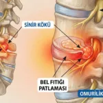 Bel Fıtığı Patlaması (Ekstrüde Disk)