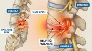 Bel Fıtığı Patlaması (Ekstrüde Disk)