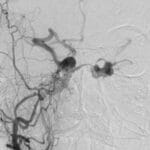 Dural Arteriovenöz Fistül (DAVF)