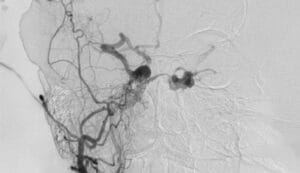 Dural Arteriovenöz Fistül (DAVF)