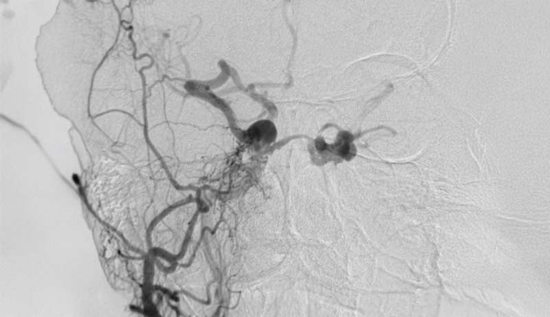 Dural Arteriovenöz Fistül (DAVF)