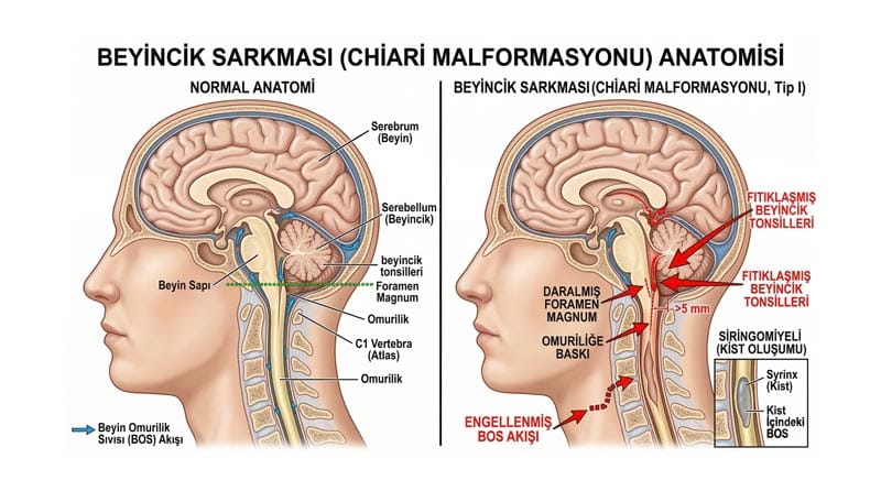 Beyincik Sarkması