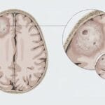 Oligodendrogliom nedir?