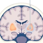 Distonide beyin pili elektrotunun bazal gangliyonlardaki globus pallidus hedefine yerleşimini gösteren beyin kesiti illüstrasyonu