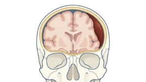 Kronik subdural hematomda kafatası ile beyin arasında hilal şeklinde biriken kanın beyni itmesini gösteren kesit