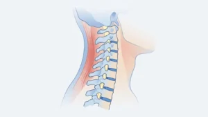 Boyun omurlarının normal C şeklindeki eğrisini kaybedip düz dizildiği boyun düzleşmesini gösteren yandan anatomik illüstrasyon
